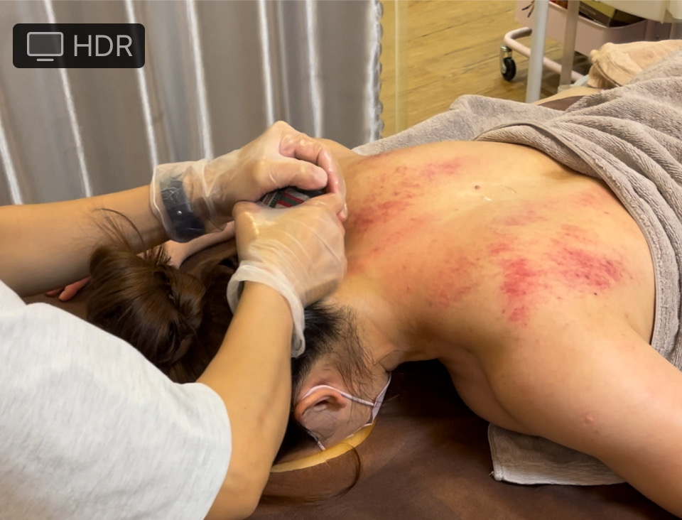 溫罐推拿過程實拍 3